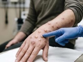Mpox cases rise to 22 in South Africa as more provinces report infections Gloved healthcare worker examines mpox skin lesions on a patient's hand and forearm