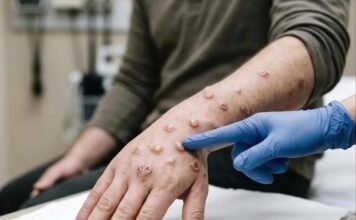 Mpox cases rise to 22 in South Africa as more provinces report infections Gloved healthcare worker examines mpox skin lesions on a patient's hand and forearm