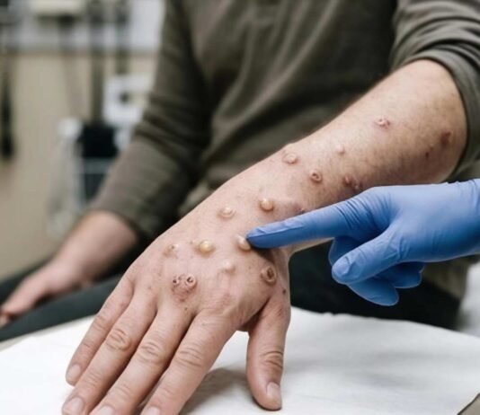 Mpox cases rise to 22 in South Africa as more provinces report infections Gloved healthcare worker examines mpox skin lesions on a patient's hand and forearm